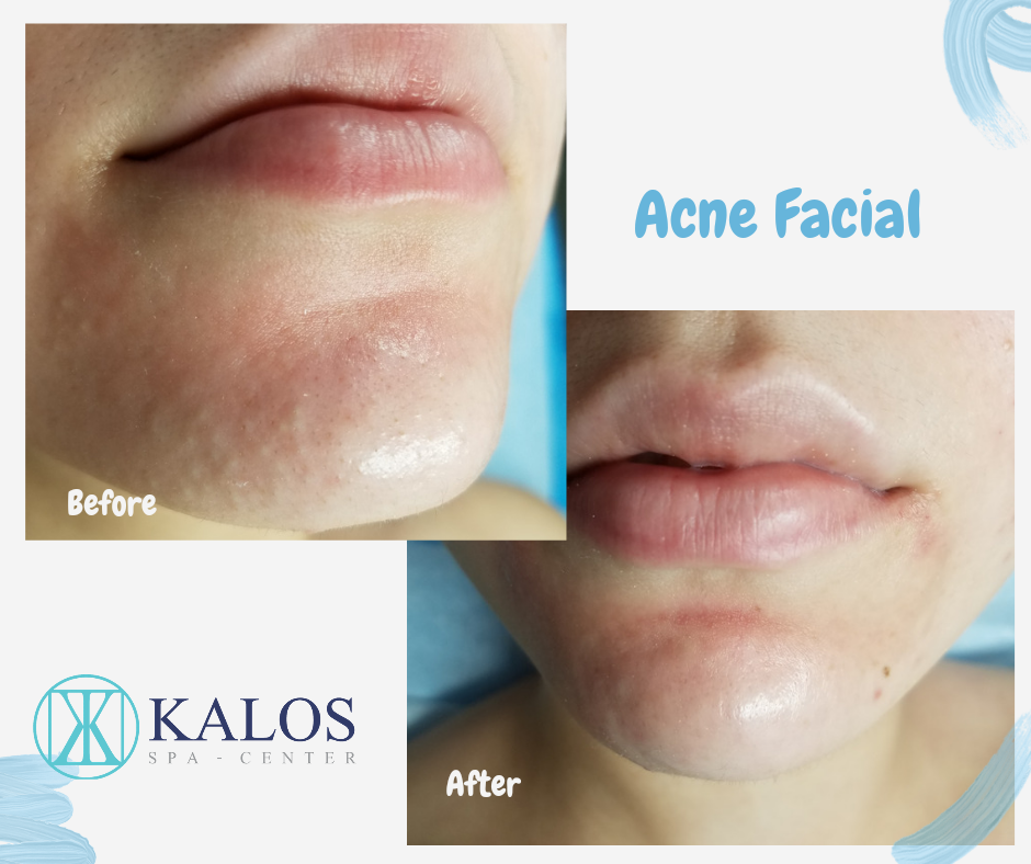 Image of a facial in Miami